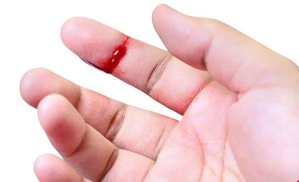 Bệnh ưa chảy máu có thể ảnh hưởng trực tiếp đến tính mạng của bạn