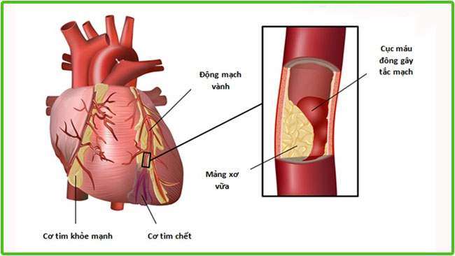 thiếu máu cơ tim nên uống thuốc gì