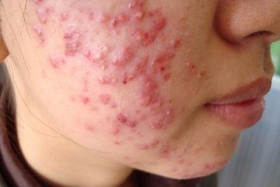 Có nhiều nguyên nhân bị mụn trứng cá
