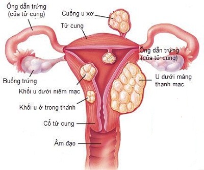 Các bệnh lý dẫn đến bị đau bụng kinh thứ phát