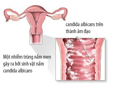 Nhiễm nấm âm đạo