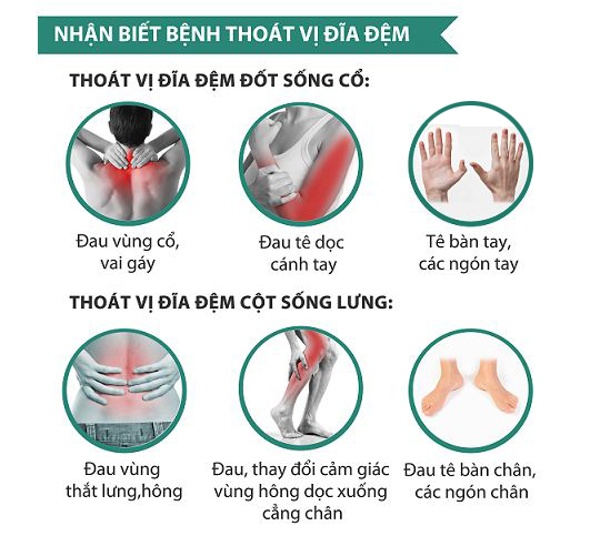 Triệu chứng bệnh thoát vị đĩa đệm