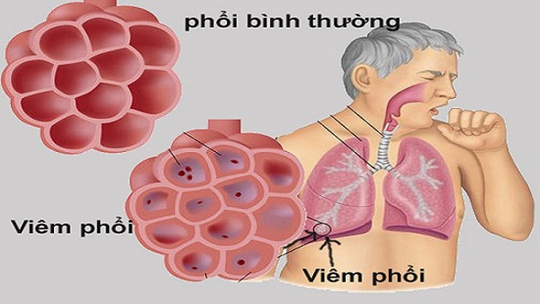 Triệu chứng viêm phổi như thế nào?