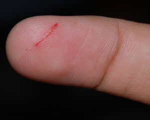 Bệnh nhân bị tiểu đường thì vết thương